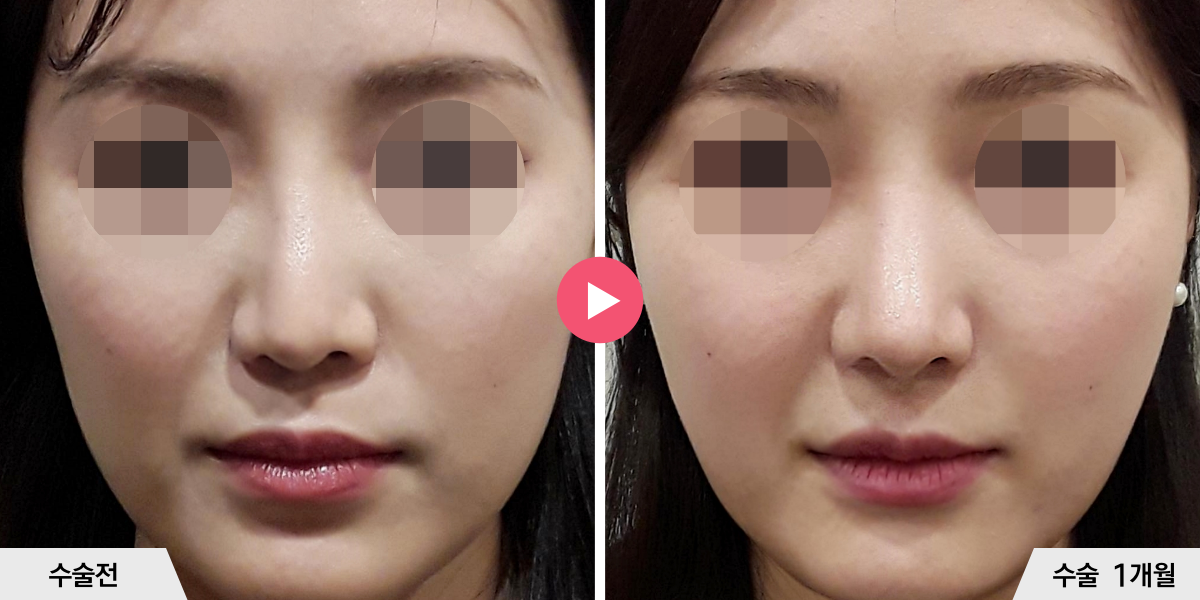 코재수술+콧대맞추기+비순각교정+진피이식