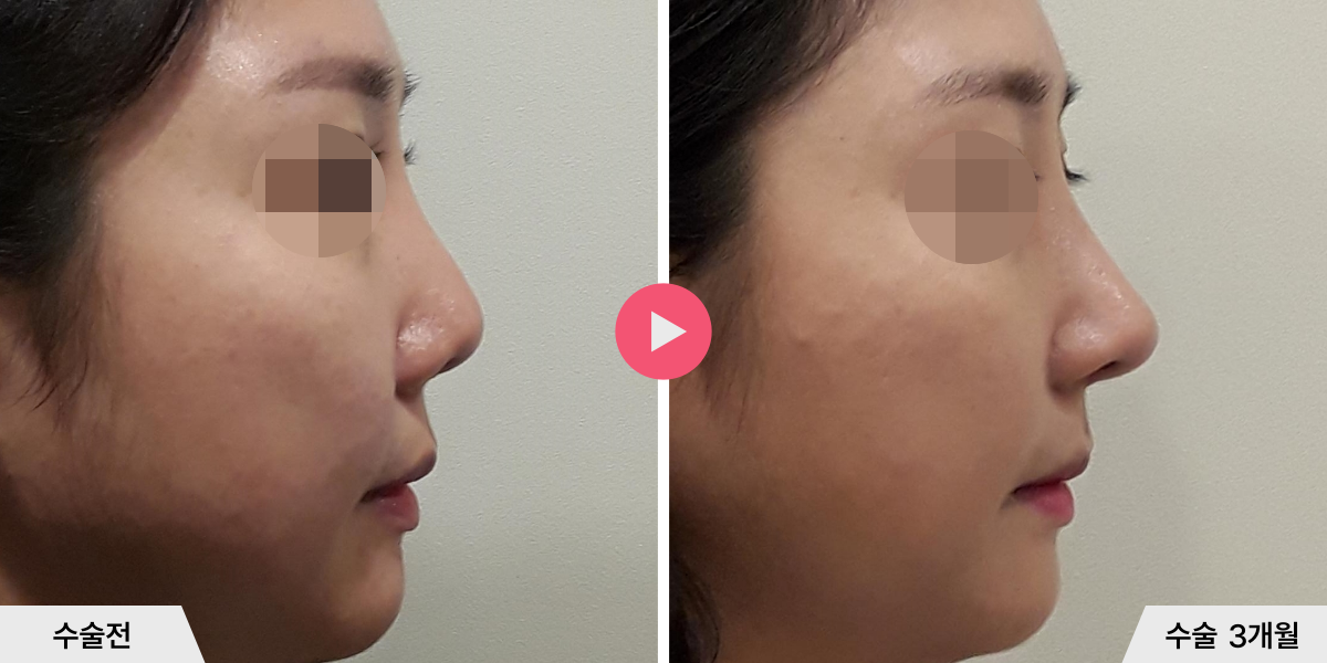 코재수술+절골+비공내리기+비중격만곡증교정