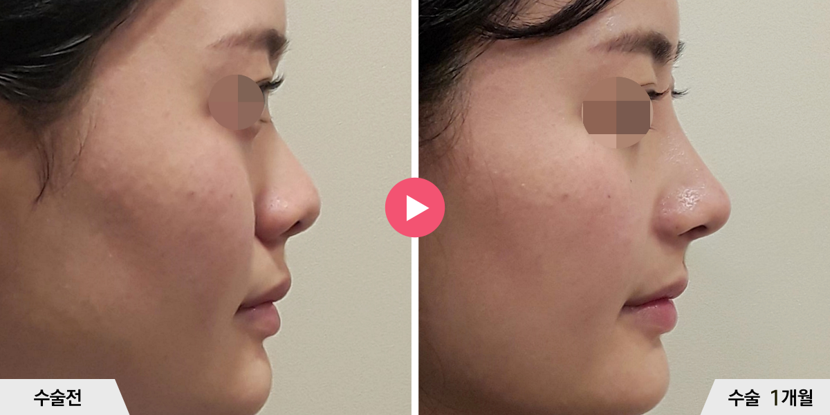 코성형+콧볼축소+귀족수술