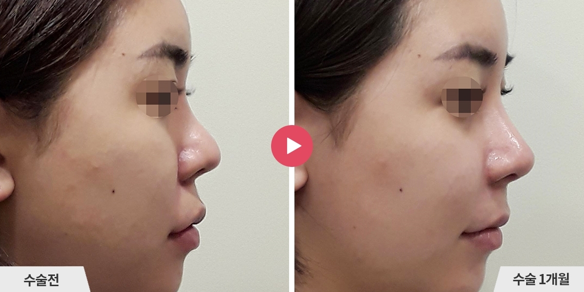 자가늑코재수술+비순각교정+콧볼축소+귀족수술+비중격만곡증교정