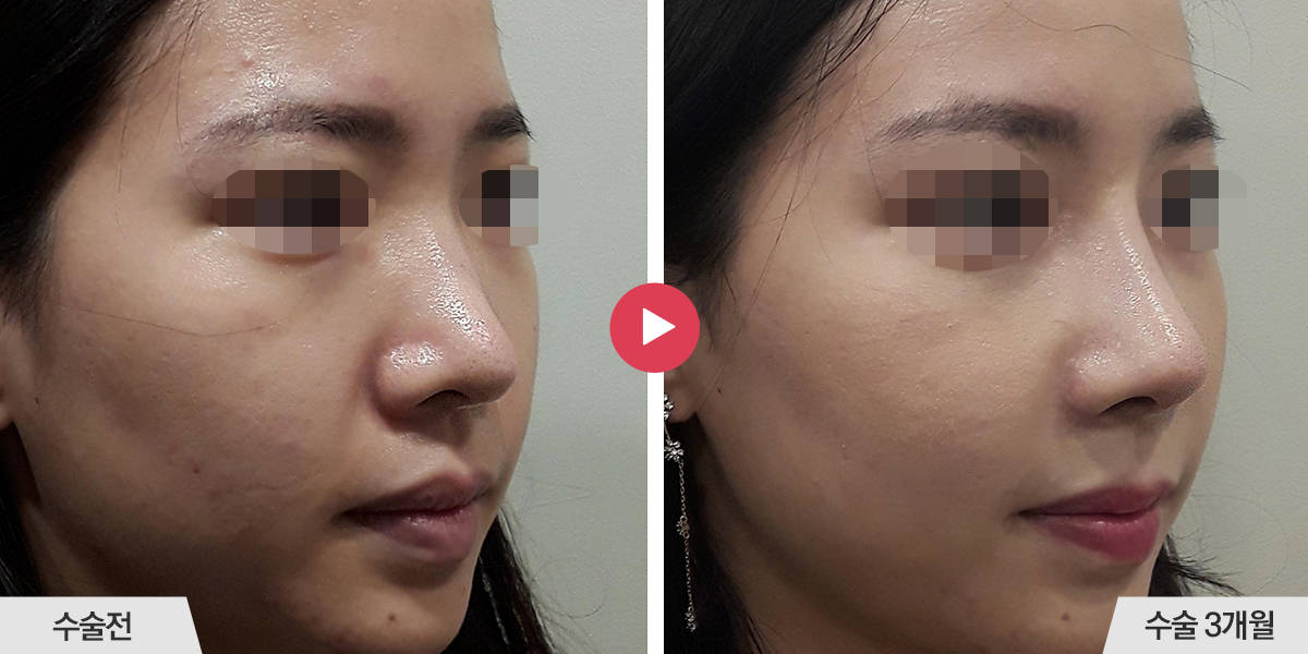 코재수술+절골+비순각교정+콧볼축소+귀족수술