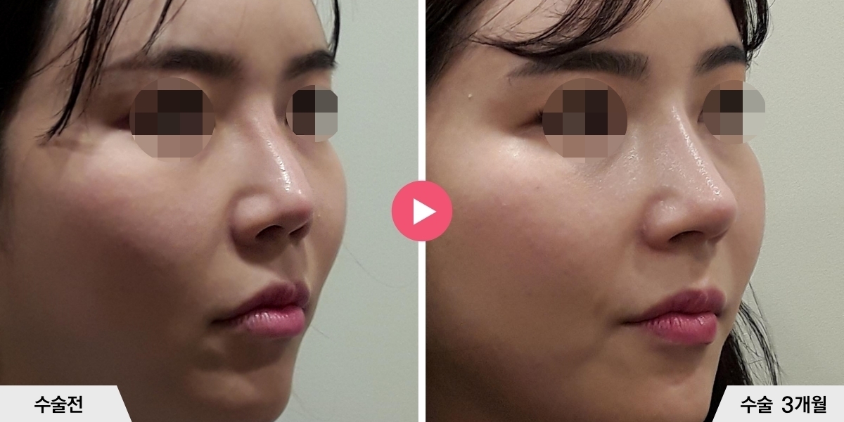 자가늑코재수술+절골+비공내리기+진피이식