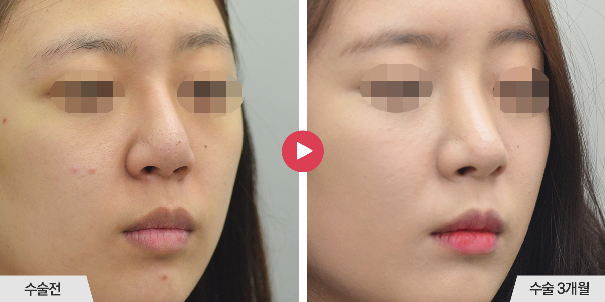 코끝이 뭉툭한 경우(복코 재수술)