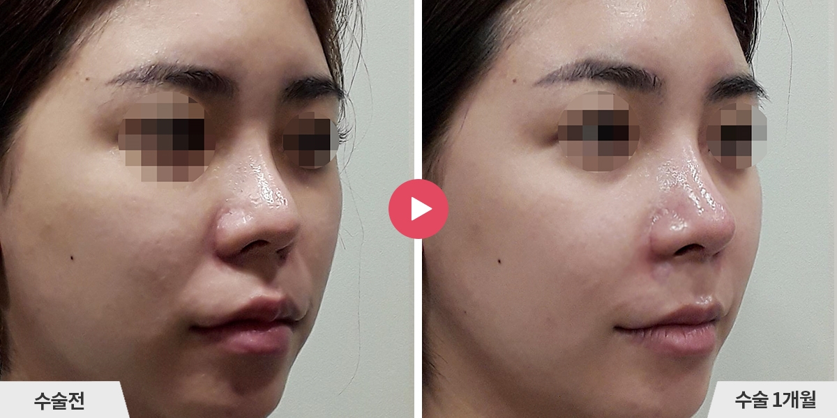 자가늑코재수술+비순각교정+콧볼축소+귀족수술+비중격만곡증교정