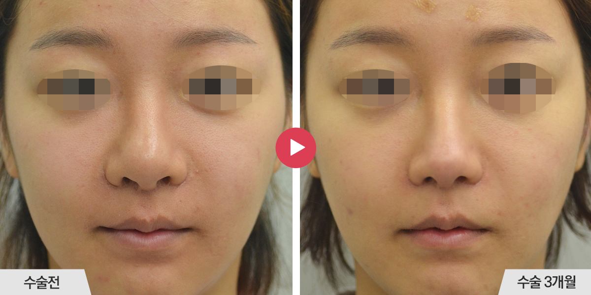 코끝이 뭉툭한 경우(복코 재수술)