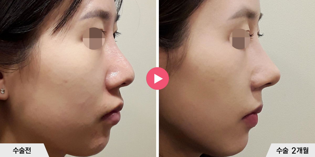코재수술+콧볼축소+귀족수술