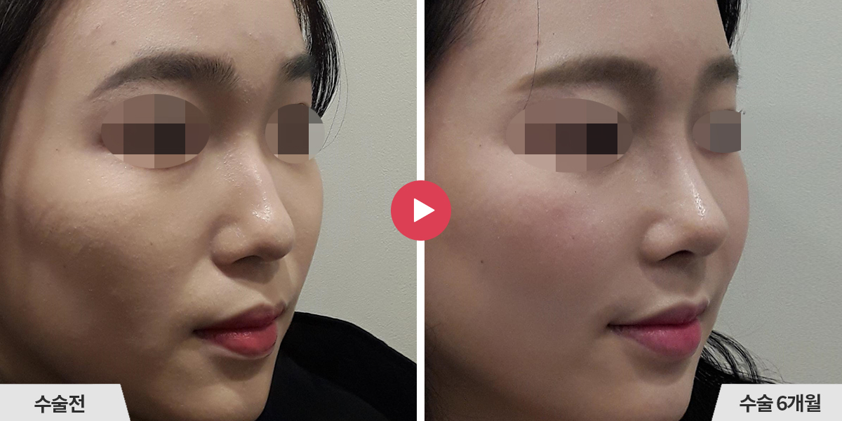 매부리코성형+비순각교정+진피이식+귀족수술