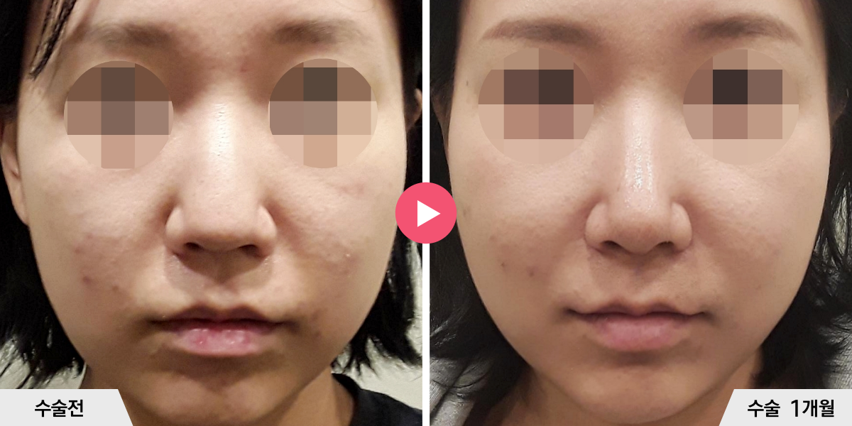 코끝성형+비순각교정+귀족수술