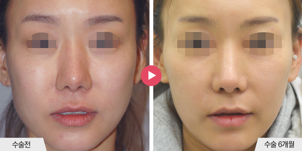 콧등이 넓거나 비대칭인 경우