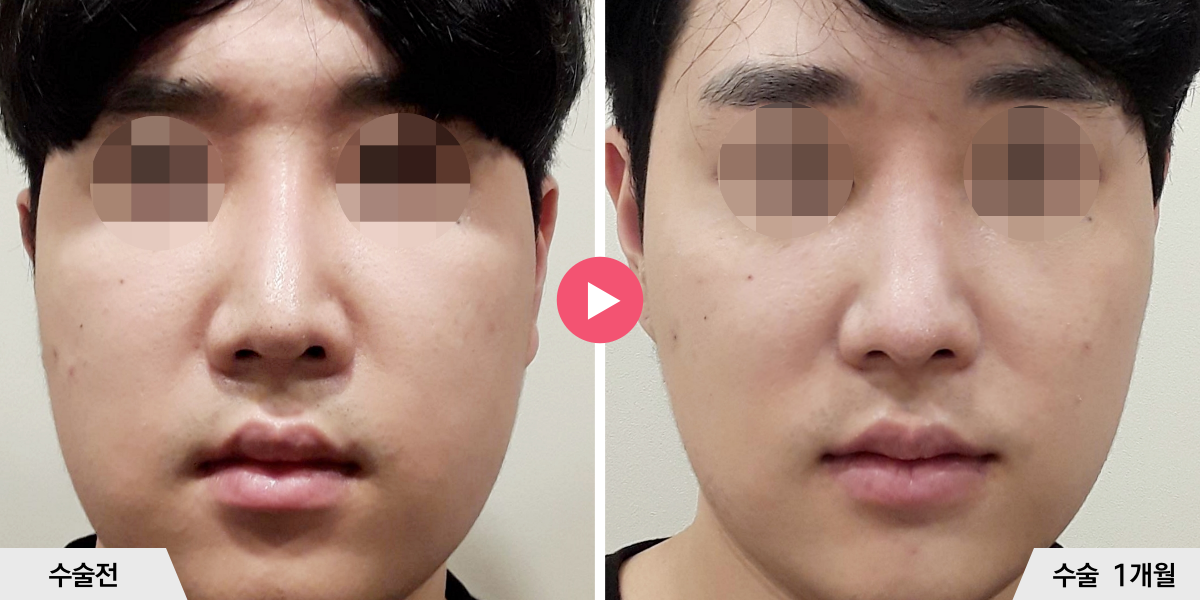 코재수술+비순각교정+진피이식