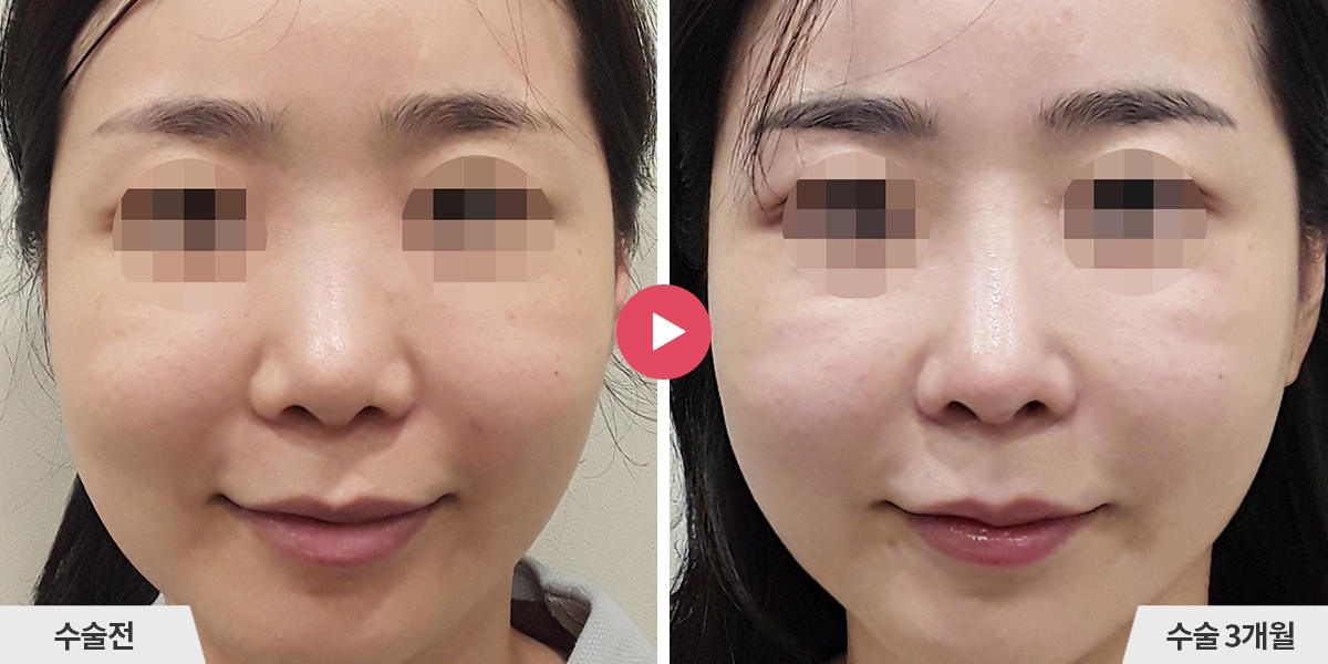 자가늑코재수술+비순각교정+진피이식+귀족수술