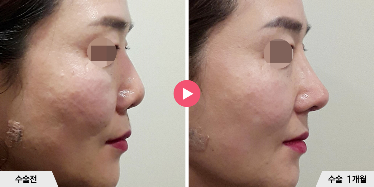 자가늑코재수술+절골+비공내리기