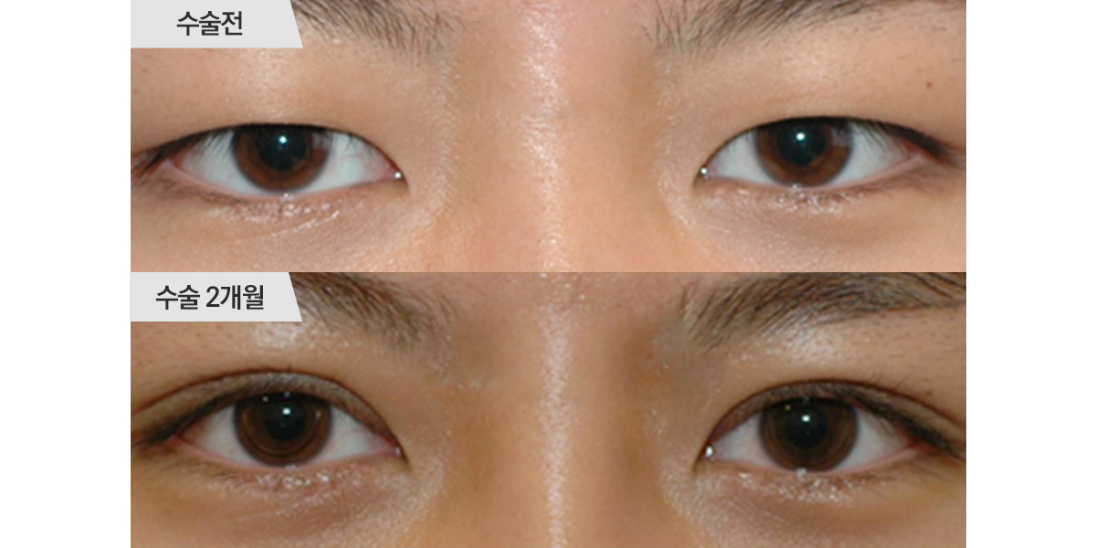 쌍꺼풀 수술, 절개법 & 앞트임 수술