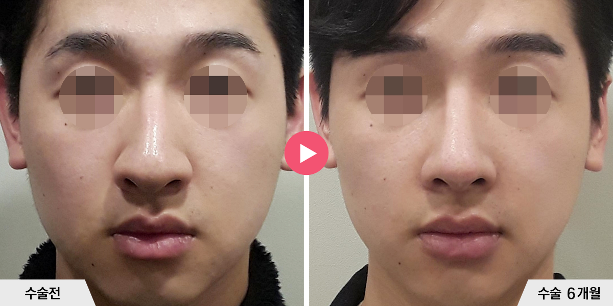 매부리코성형+절골+콧볼축소+귀족수술+비중격만곡증교정