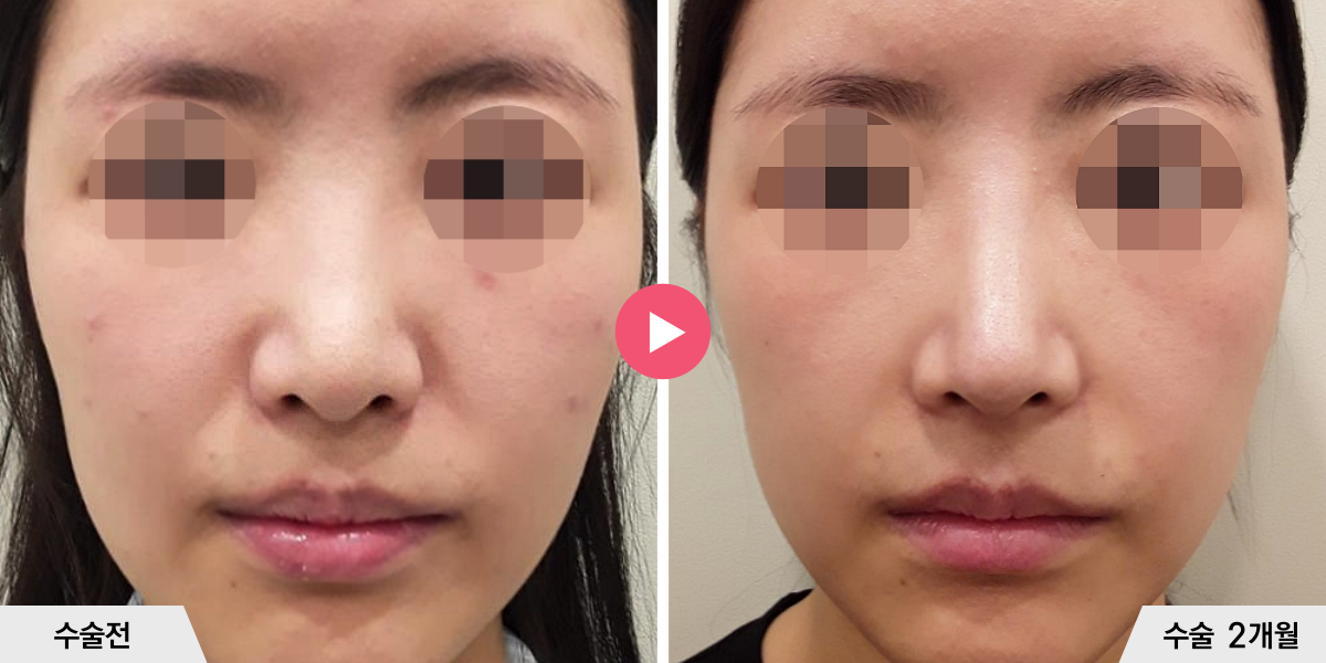 코성형+절골+진피이식+귀족수술