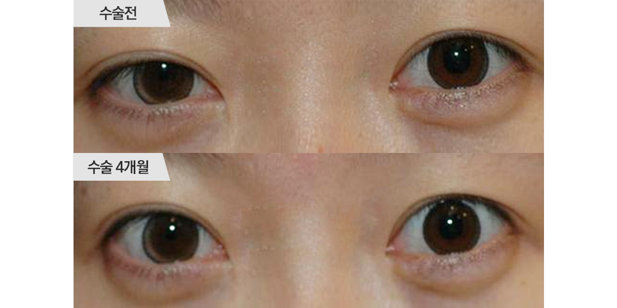 눈매교정 수술