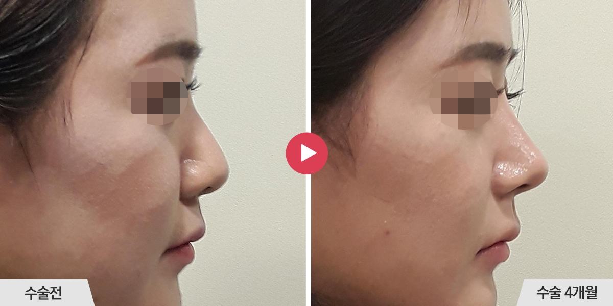 코성형+절골+콧볼축소+귀족수술