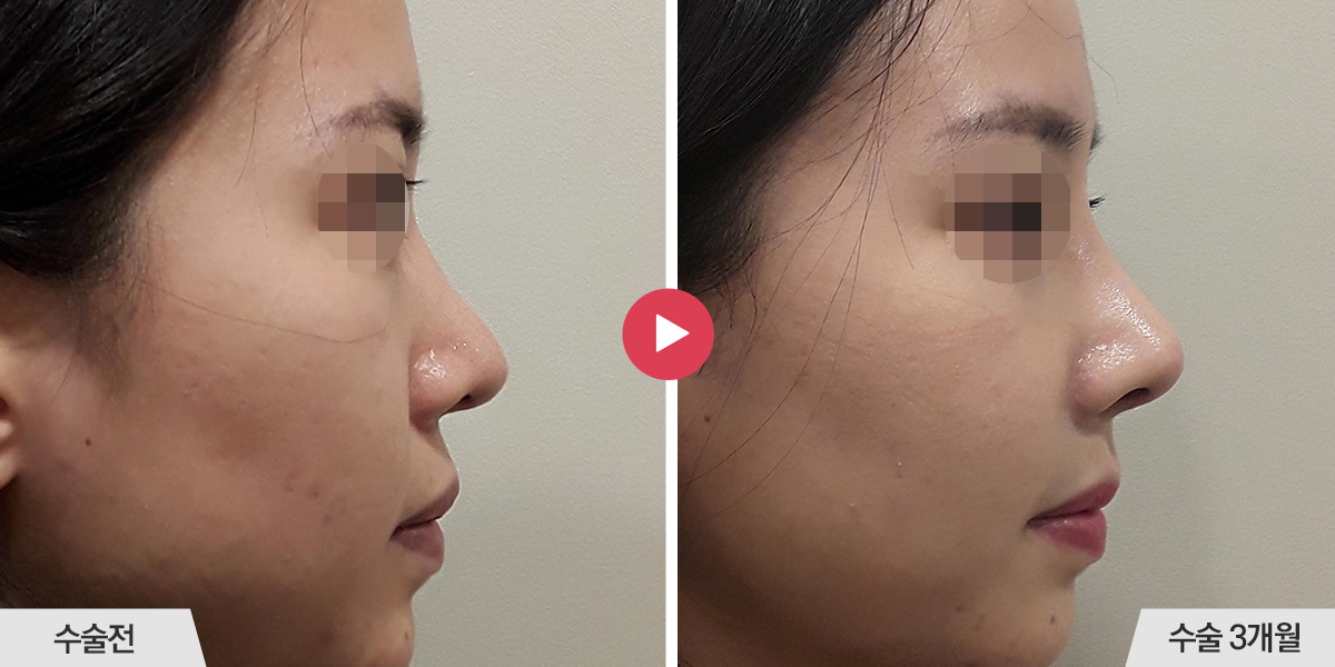 코재수술+절골+비순각교정+콧볼축소+귀족수술