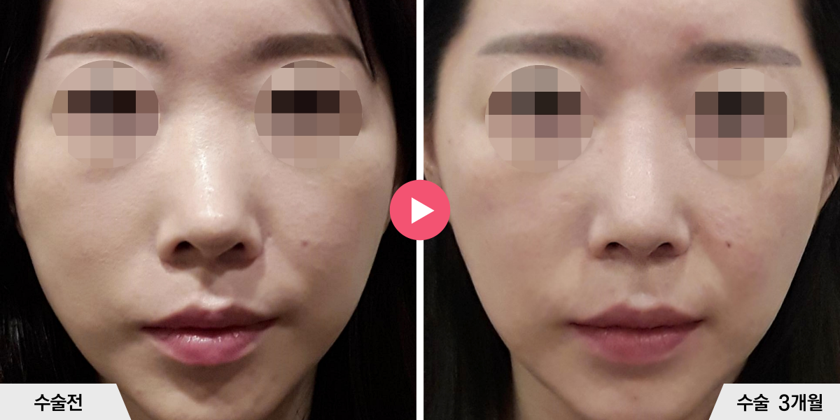 자가늑코재수술+절골+비순각교정+비공내리기+진피이식