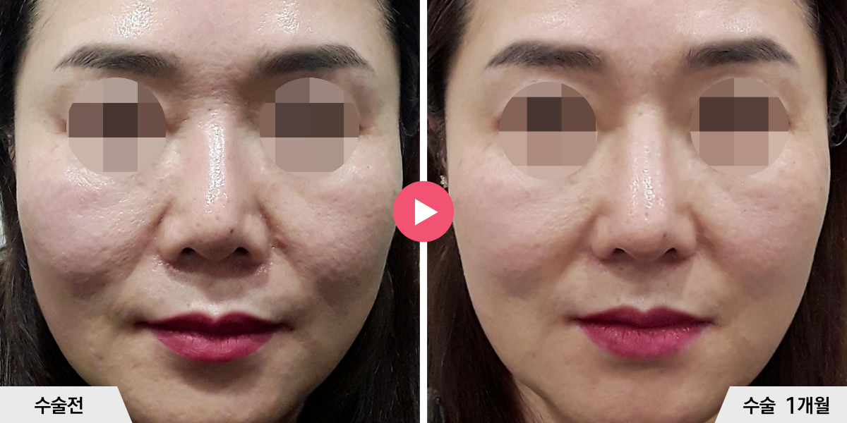 자가늑코재수술+절골+비공내리기