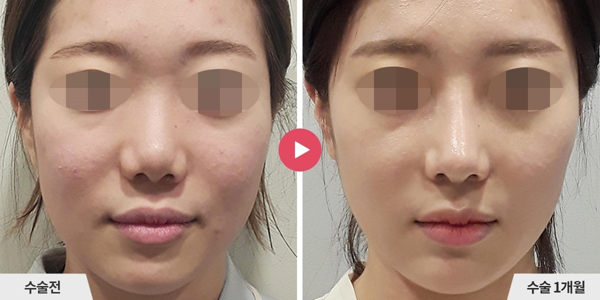 코성형+비순각교정+콧볼축소+귀족수술