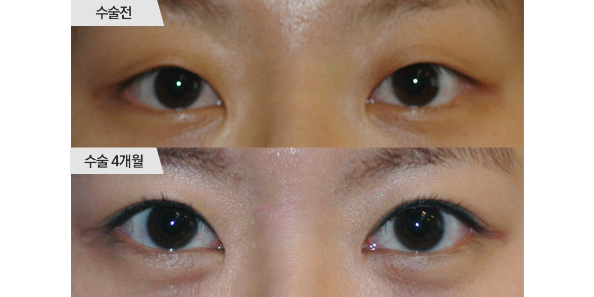 쌍꺼풀 수술, 매몰법 & 앞트임 수술