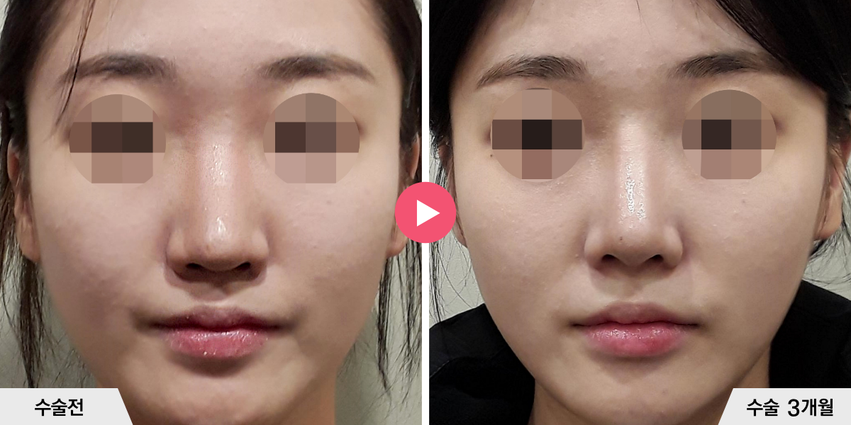 코재수술+비순각교정