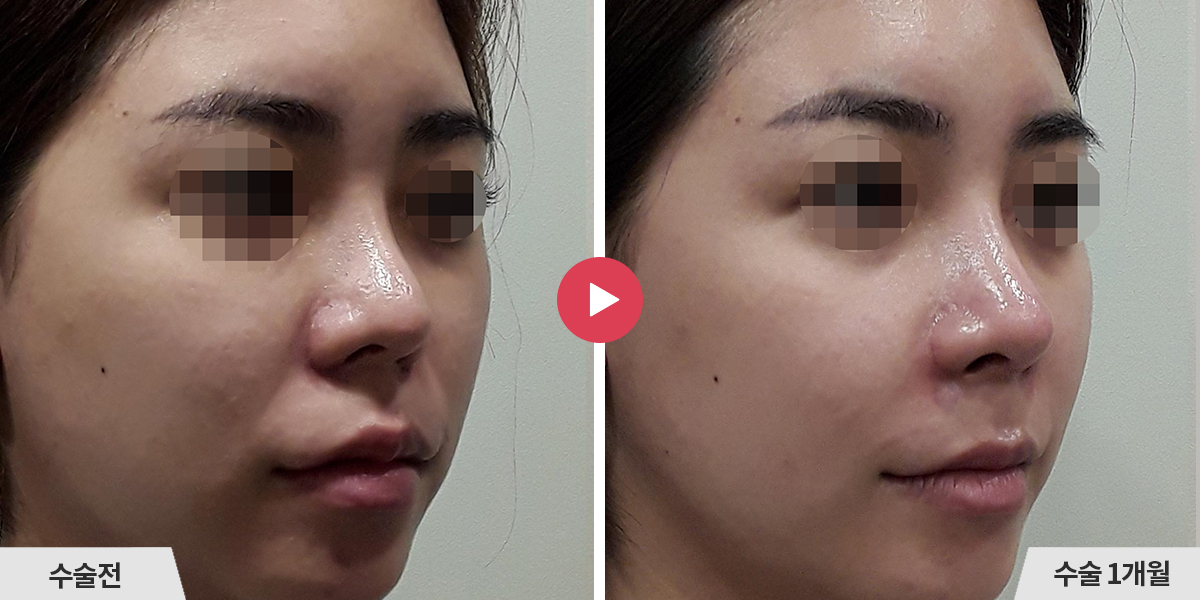 자가늑코재수술+콧볼축소+귀족수술