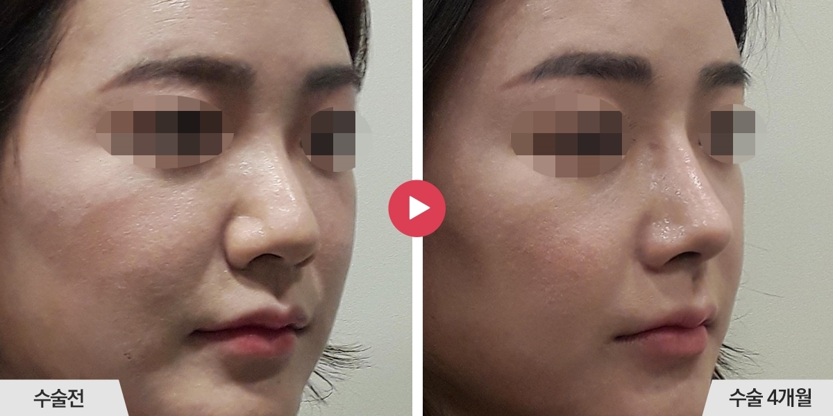 코성형+절골+콧볼축소+귀족수술