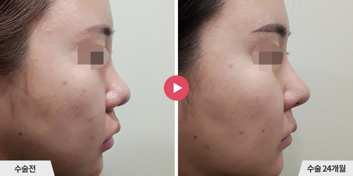 복코성형+비순각교정+콧볼축소+귀족수술