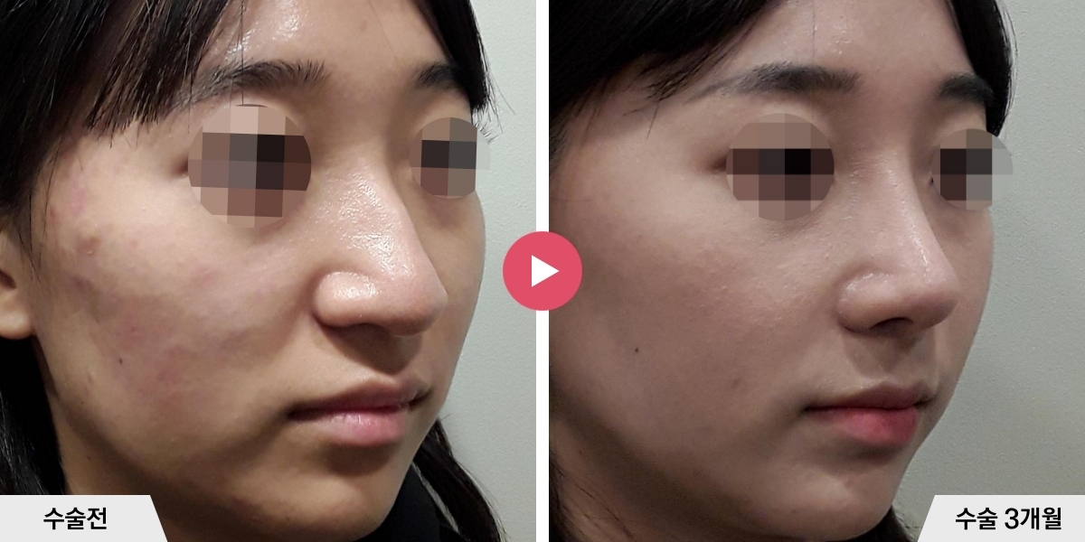 매부리코성형+절골+콧볼축소+귀족수술