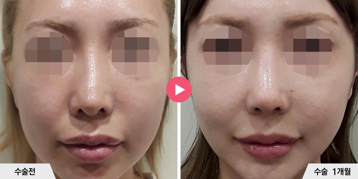 코재수술+절골+비공내리기+진피이식+귀족수술