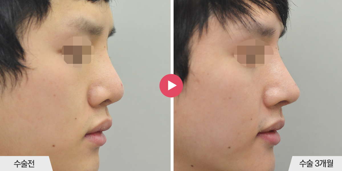 콧등이 넓거나 비대칭인 경우