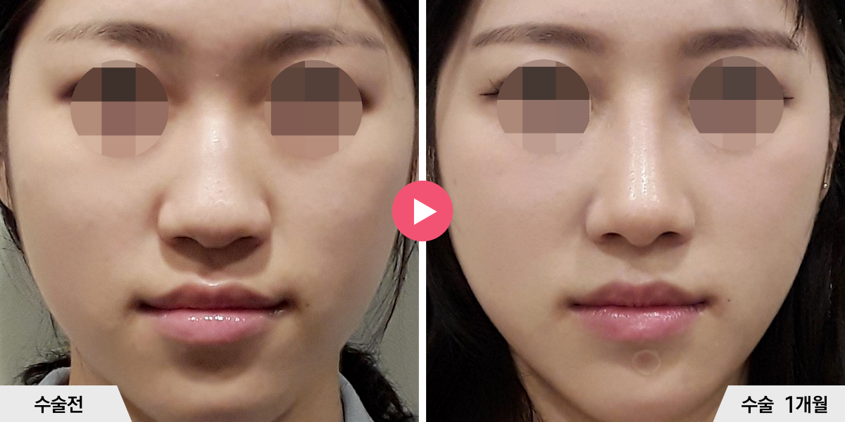 매부리코성형+절골+비순각교정+진피이식