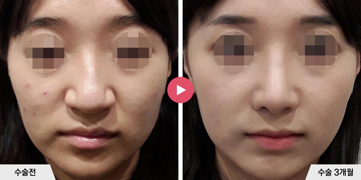매부리코성형+절골+콧볼축소+귀족수술