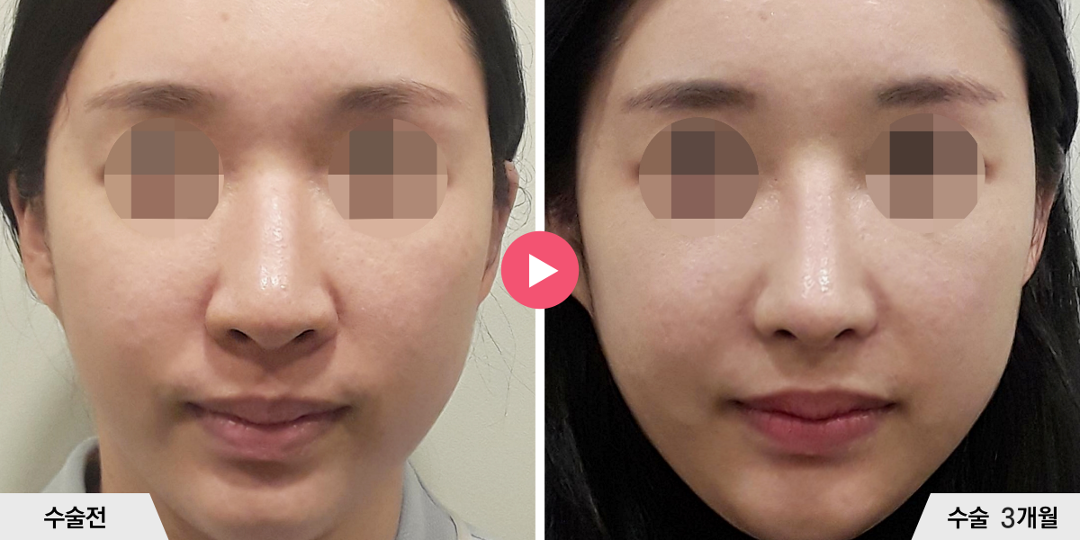코성형+절골+콧볼축소+귀족수술+비중격만곡증교정