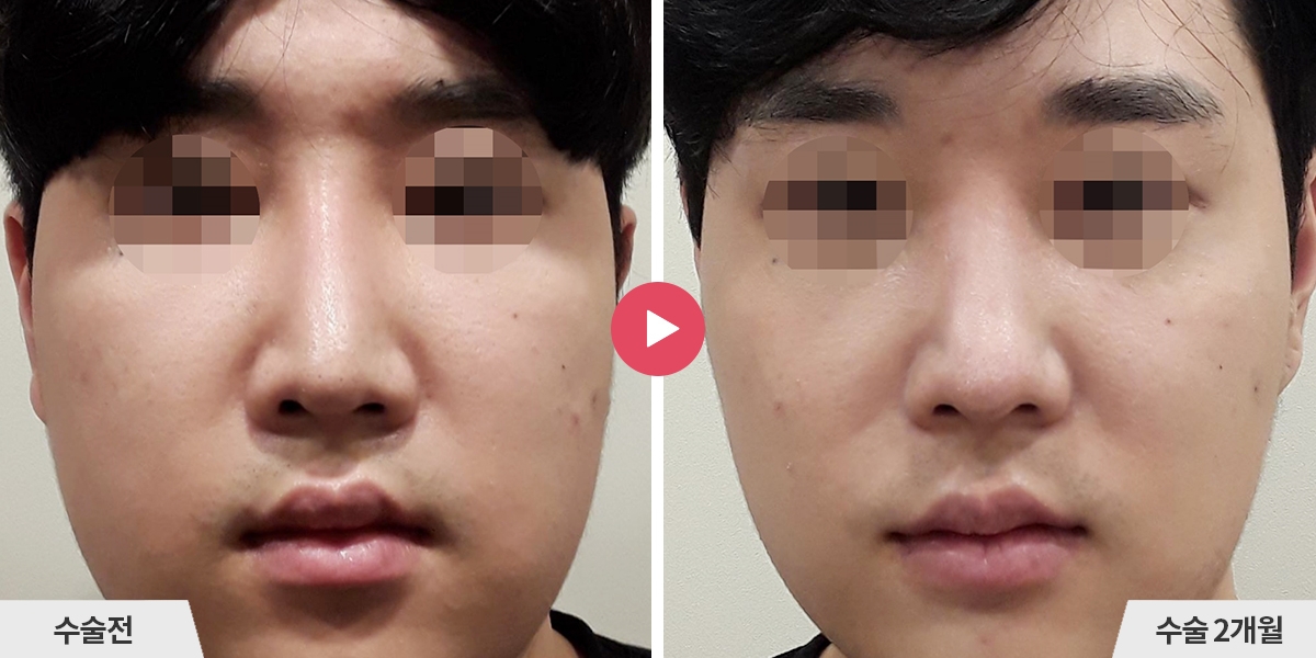 코재수술+절골+비순각교정+진피이식