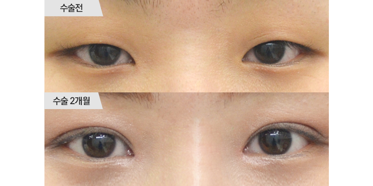 쌍꺼풀 수술, 절개법 & 앞트임 수술