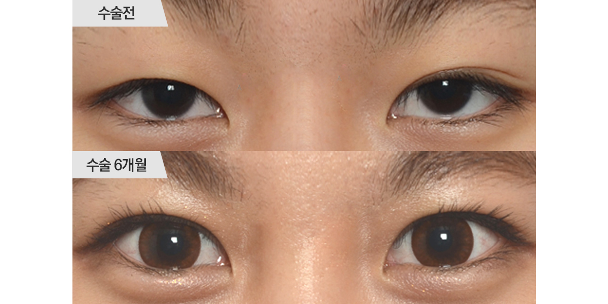 눈매교정 수술