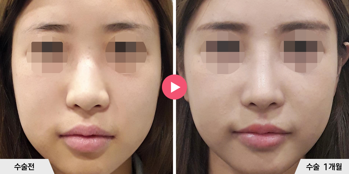 매부리코성형+절골+진피이식