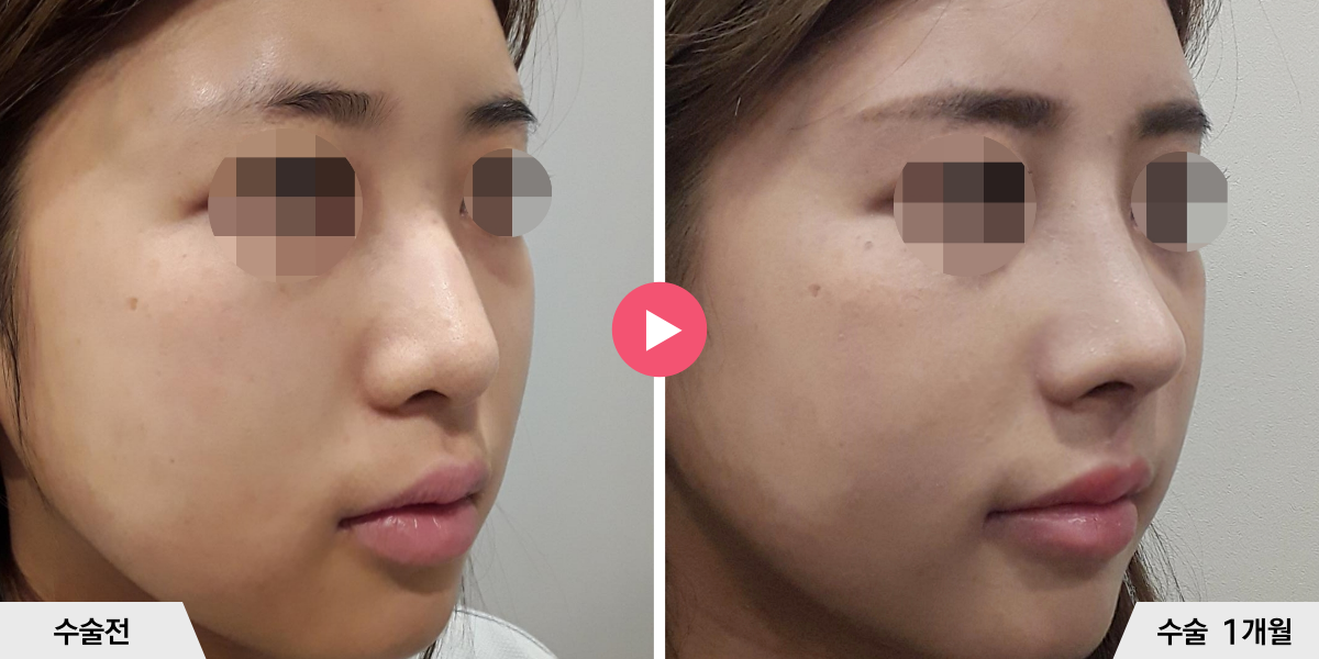 매부리코성형+절골+진피이식